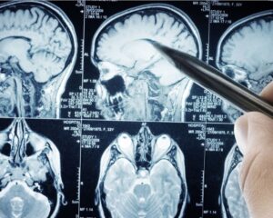 Relación entre un tumor cerebral y la pérdida de memoria