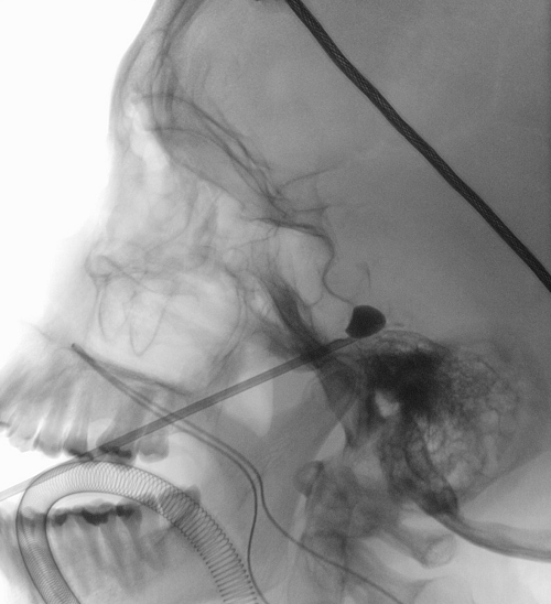 imagen escáner neuralgia del trigémino